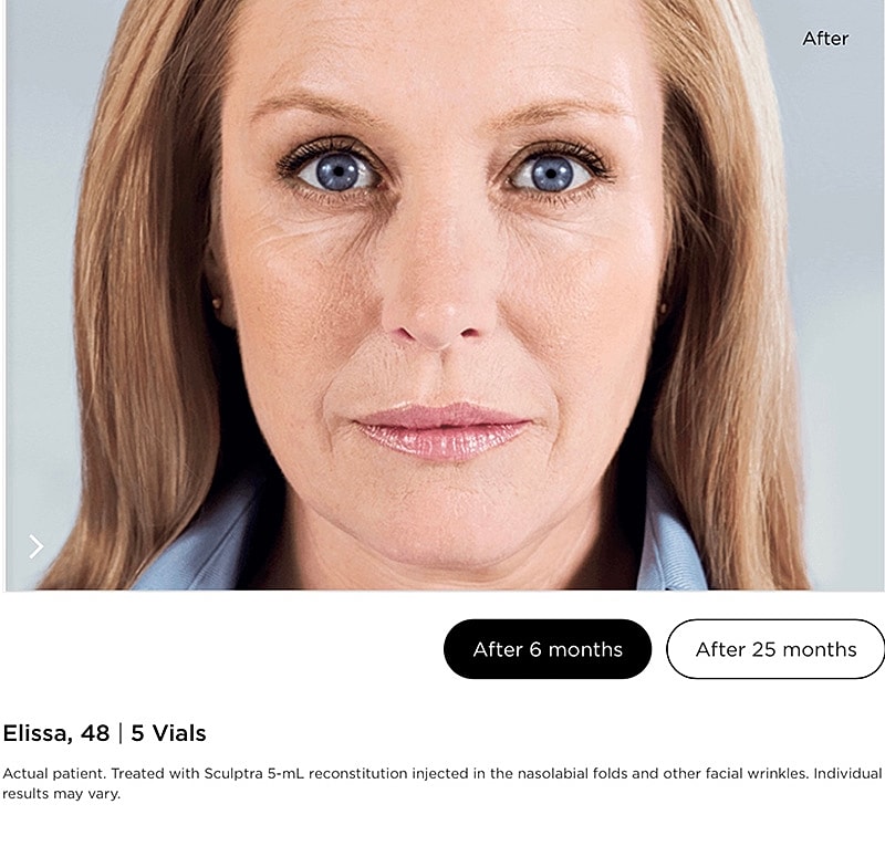 Sculptra Gallery Before & After