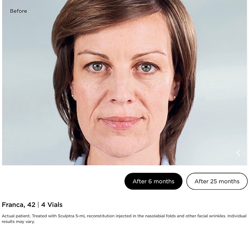 Sculptra Gallery Before & After