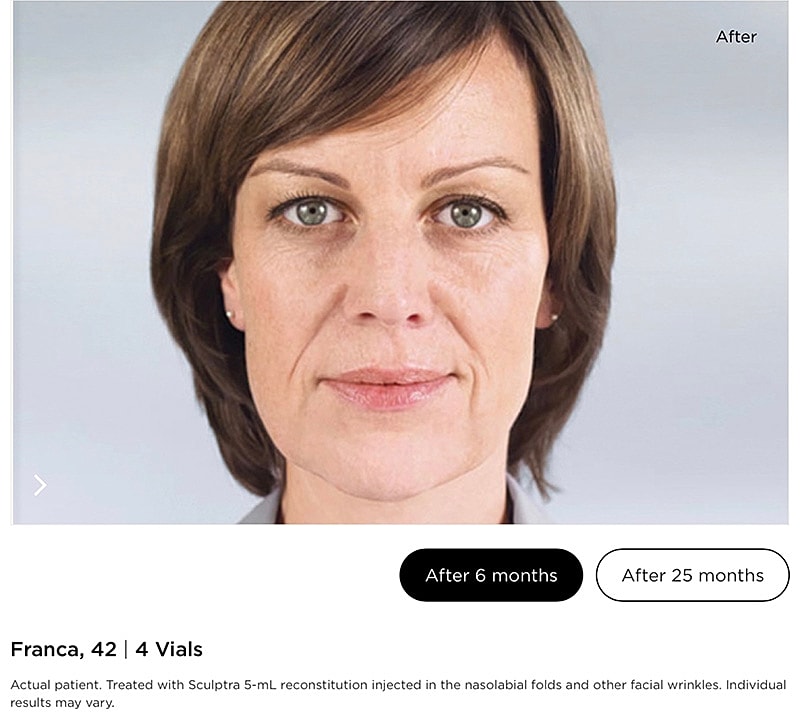 Sculptra Gallery Before & After