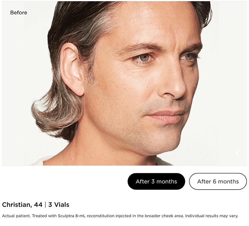 Sculptra Gallery Before & After