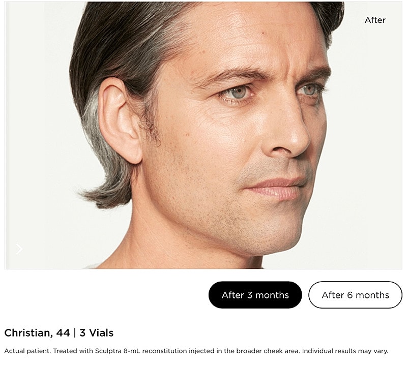 Sculptra Gallery Before & After