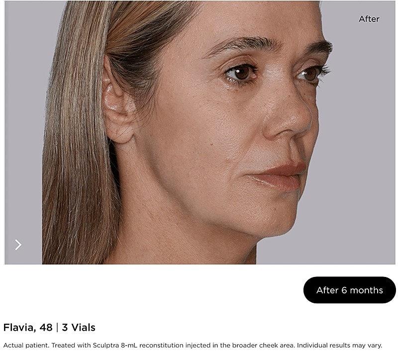 Sculptra Gallery Before & After