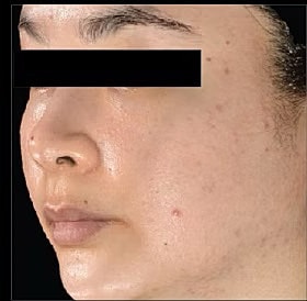 Sylfirm X Gallery Before & After