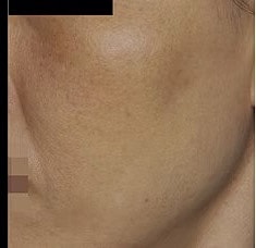 Sylfirm X Gallery Before & After