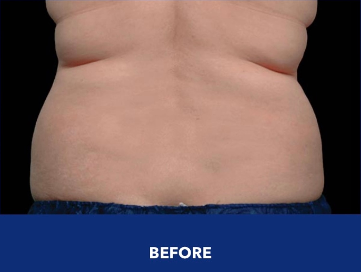 CoolSculpting Gallery Before & After