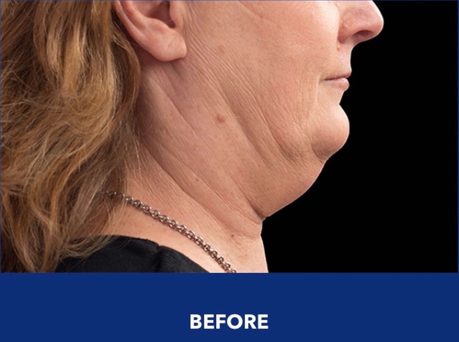 CoolSculpting Gallery Before & After