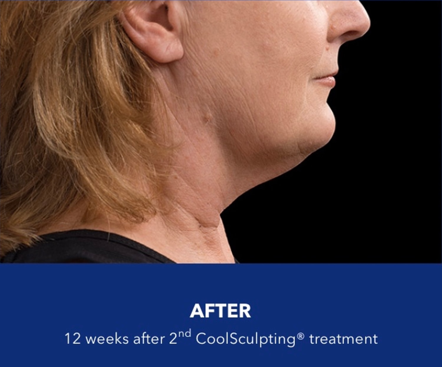 CoolSculpting Gallery Before & After