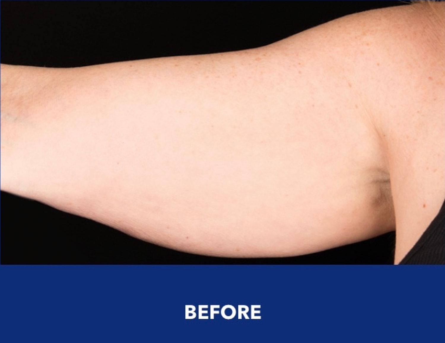 CoolSculpting Gallery Before & After