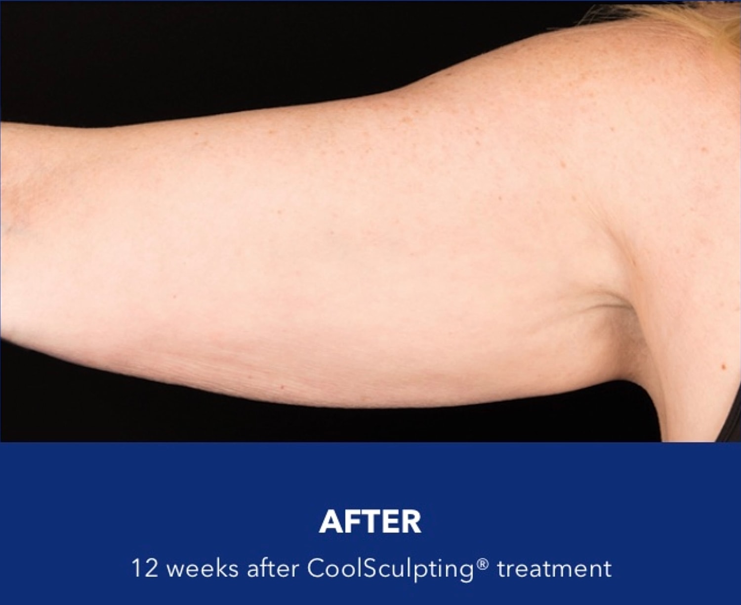 CoolSculpting Gallery Before & After