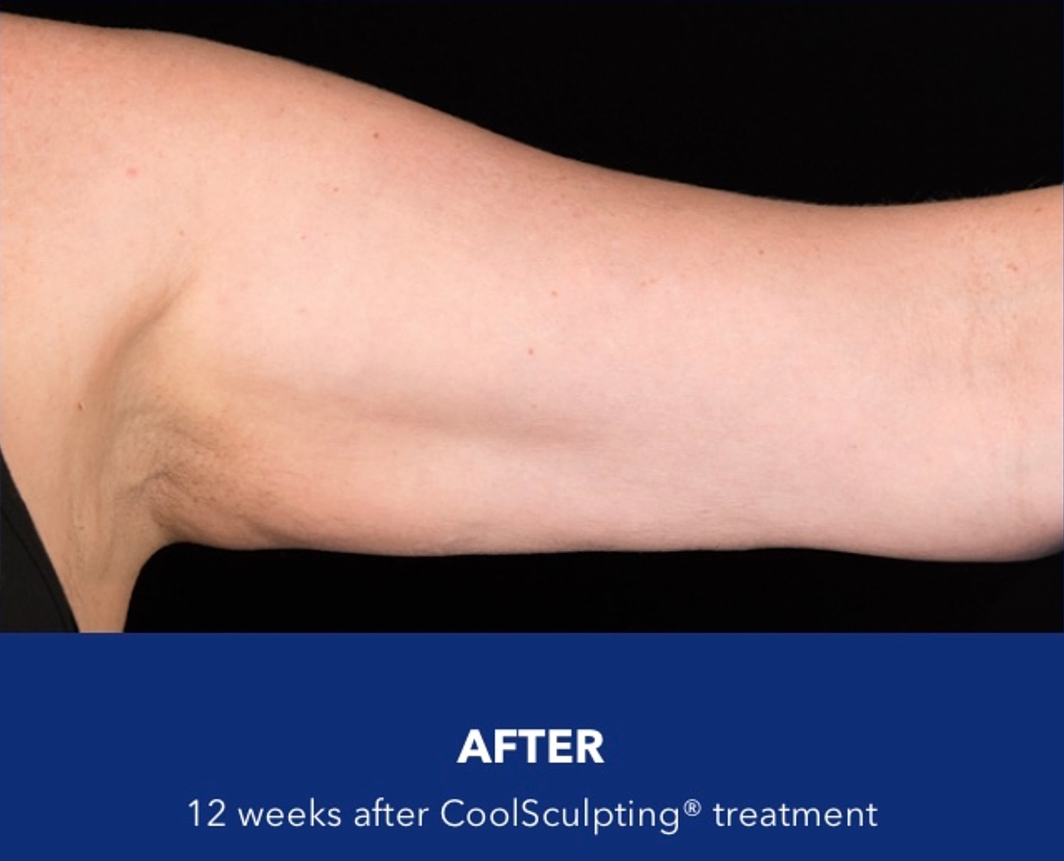 CoolSculpting Gallery Before & After
