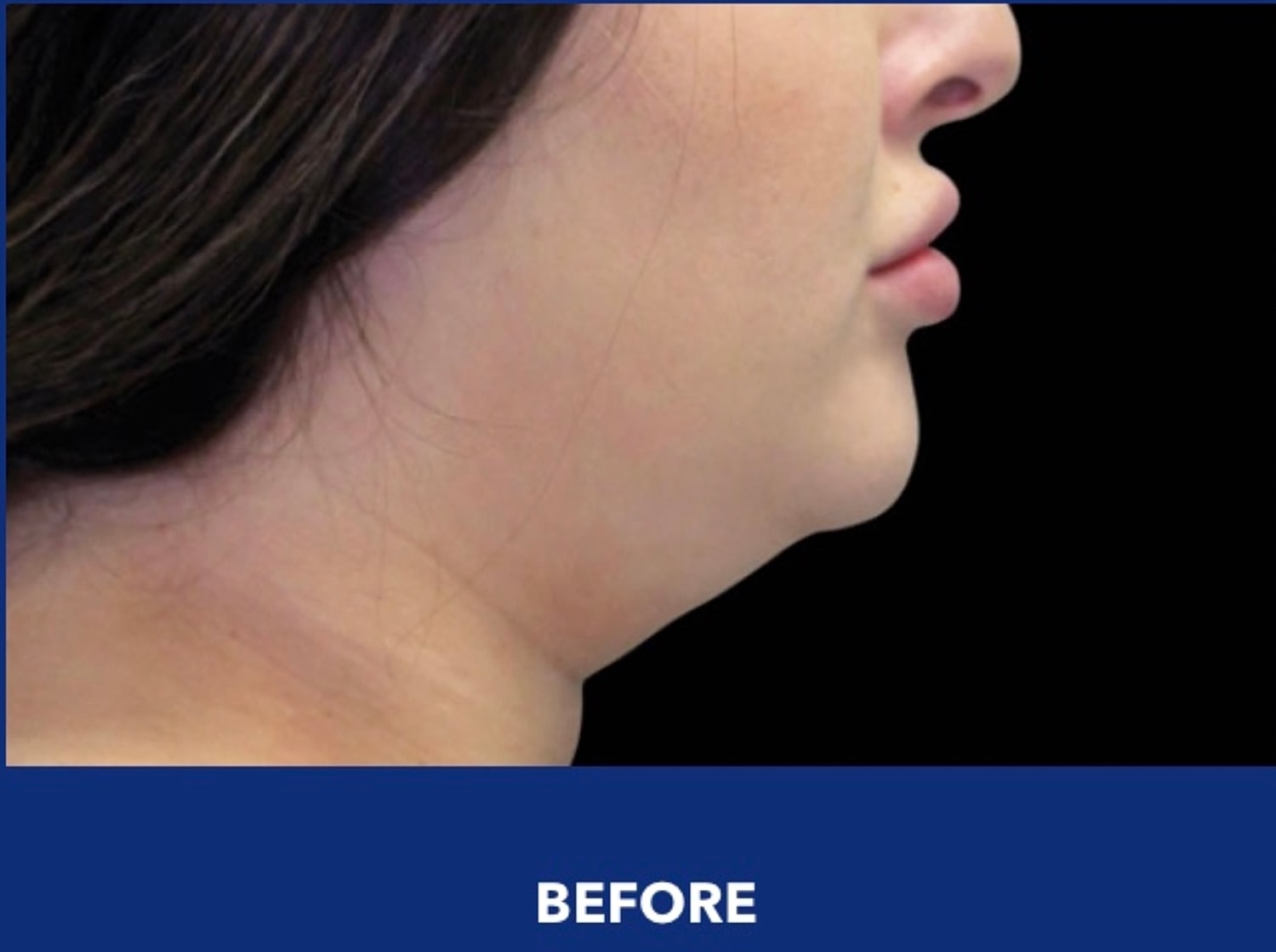 CoolSculpting Gallery Before & After