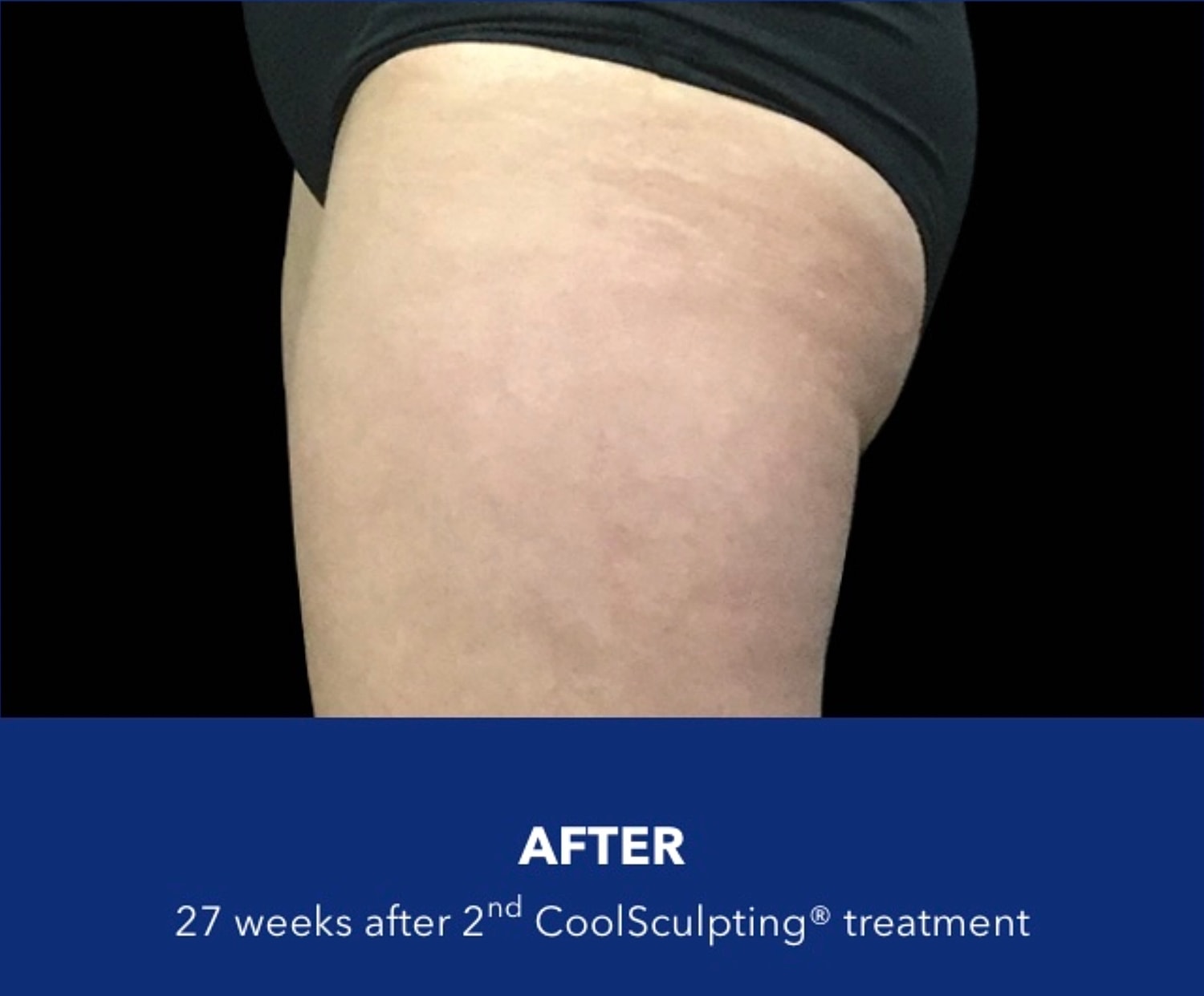 CoolSculpting Gallery Before & After