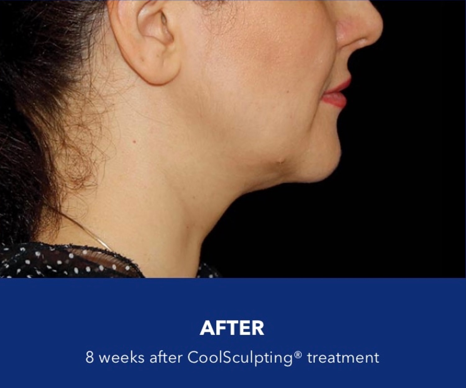CoolSculpting Gallery Before & After