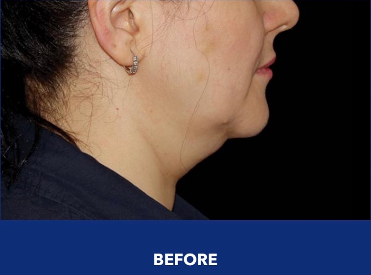CoolSculpting Gallery Before & After
