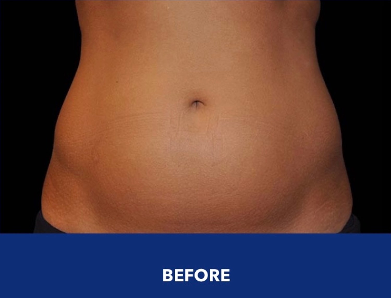 CoolSculpting Gallery Before & After