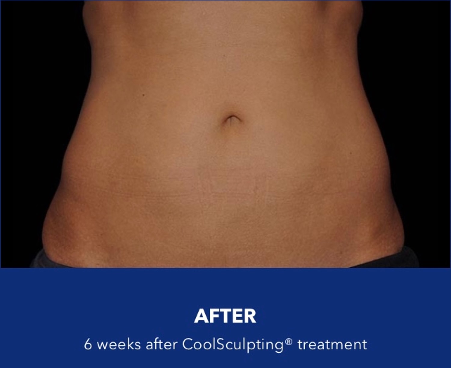 CoolSculpting Gallery Before & After