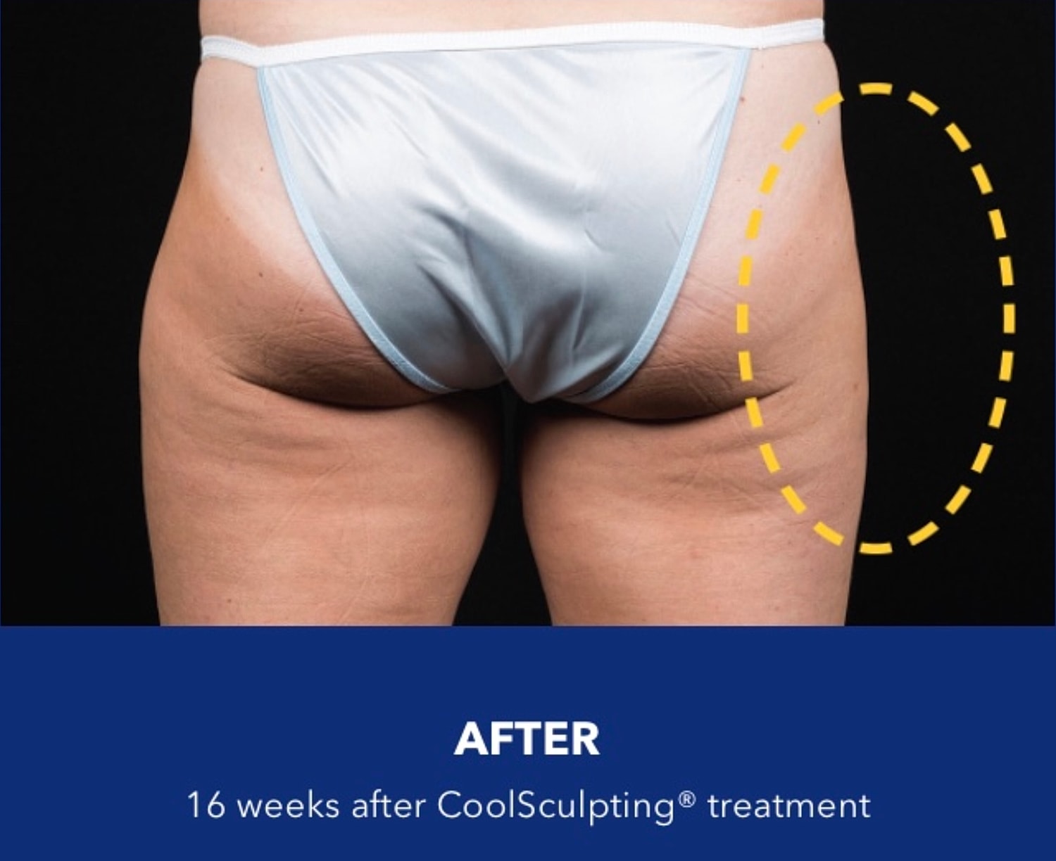 CoolSculpting Gallery Before & After