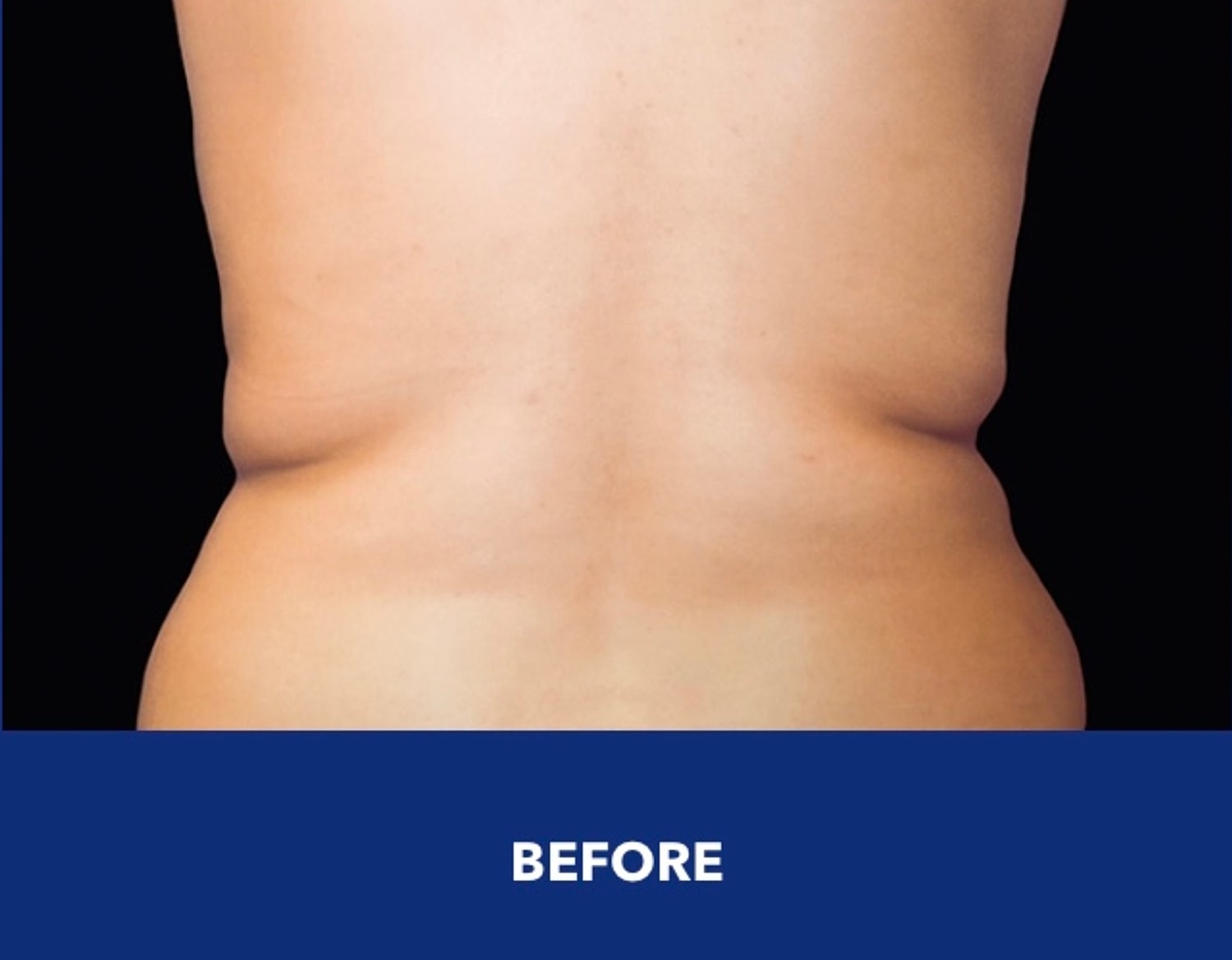 CoolSculpting Gallery Before & After