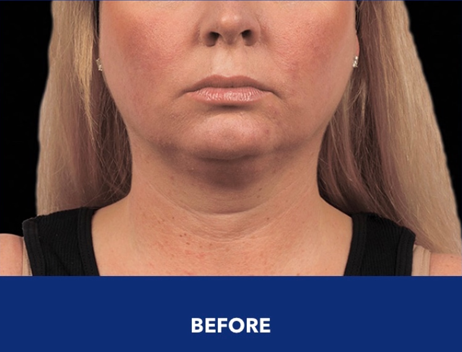 CoolSculpting Gallery Before & After