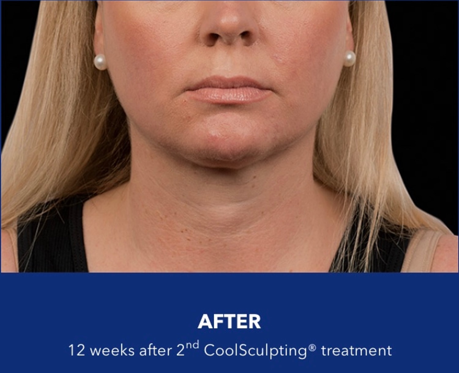 CoolSculpting Gallery Before & After