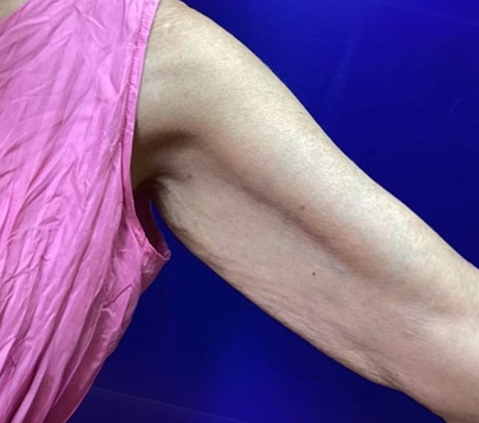 Sofwave Gallery Before & After