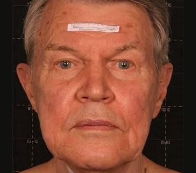 Sofwave Gallery Before & After