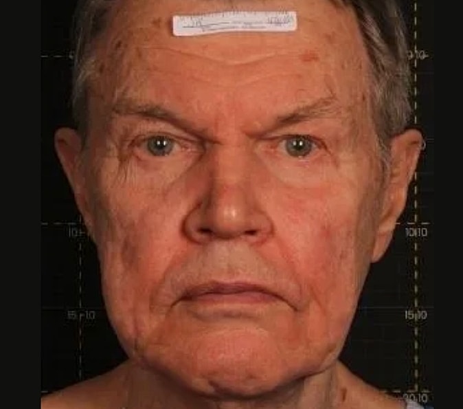 Sofwave Gallery Before & After