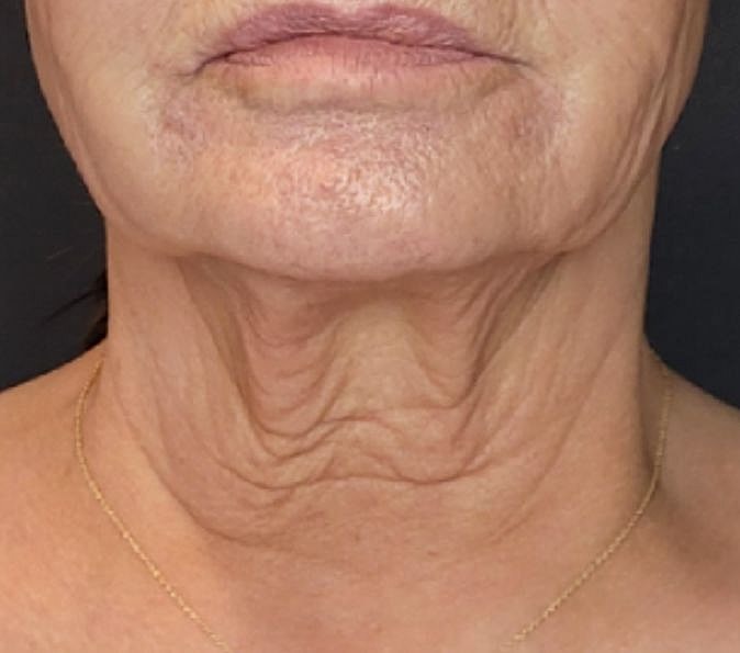 Sofwave Gallery Before & After