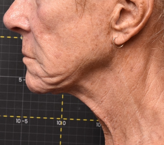 Sofwave Gallery Before & After