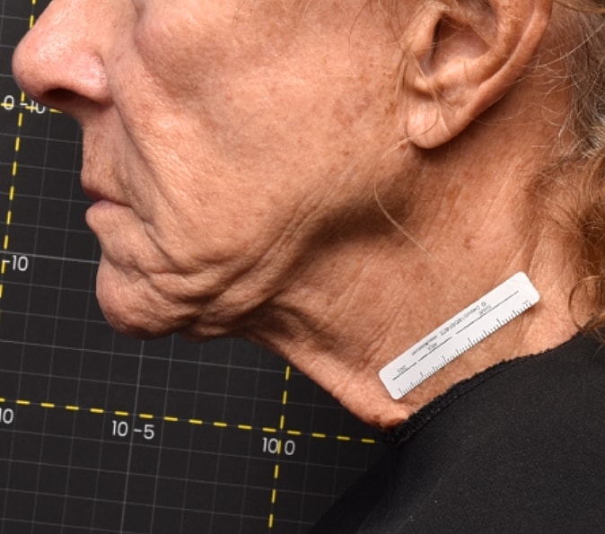 Sofwave Gallery Before & After