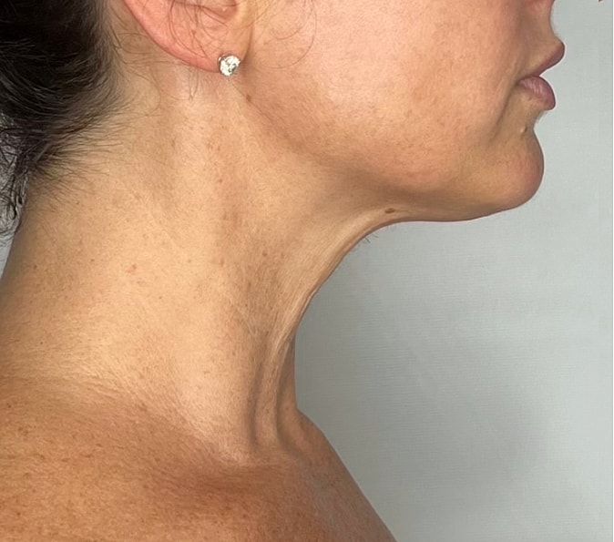 Sofwave Gallery Before & After