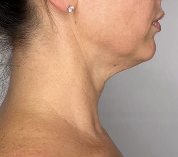 Sofwave Gallery Before & After