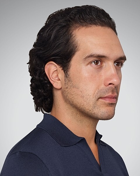 Juvederm Gallery Before & After