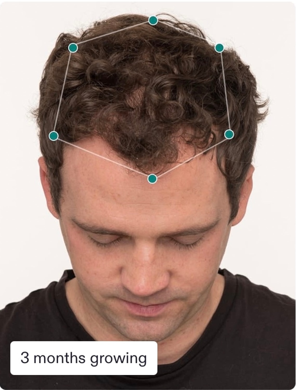 Nutrafol Gallery Before & After