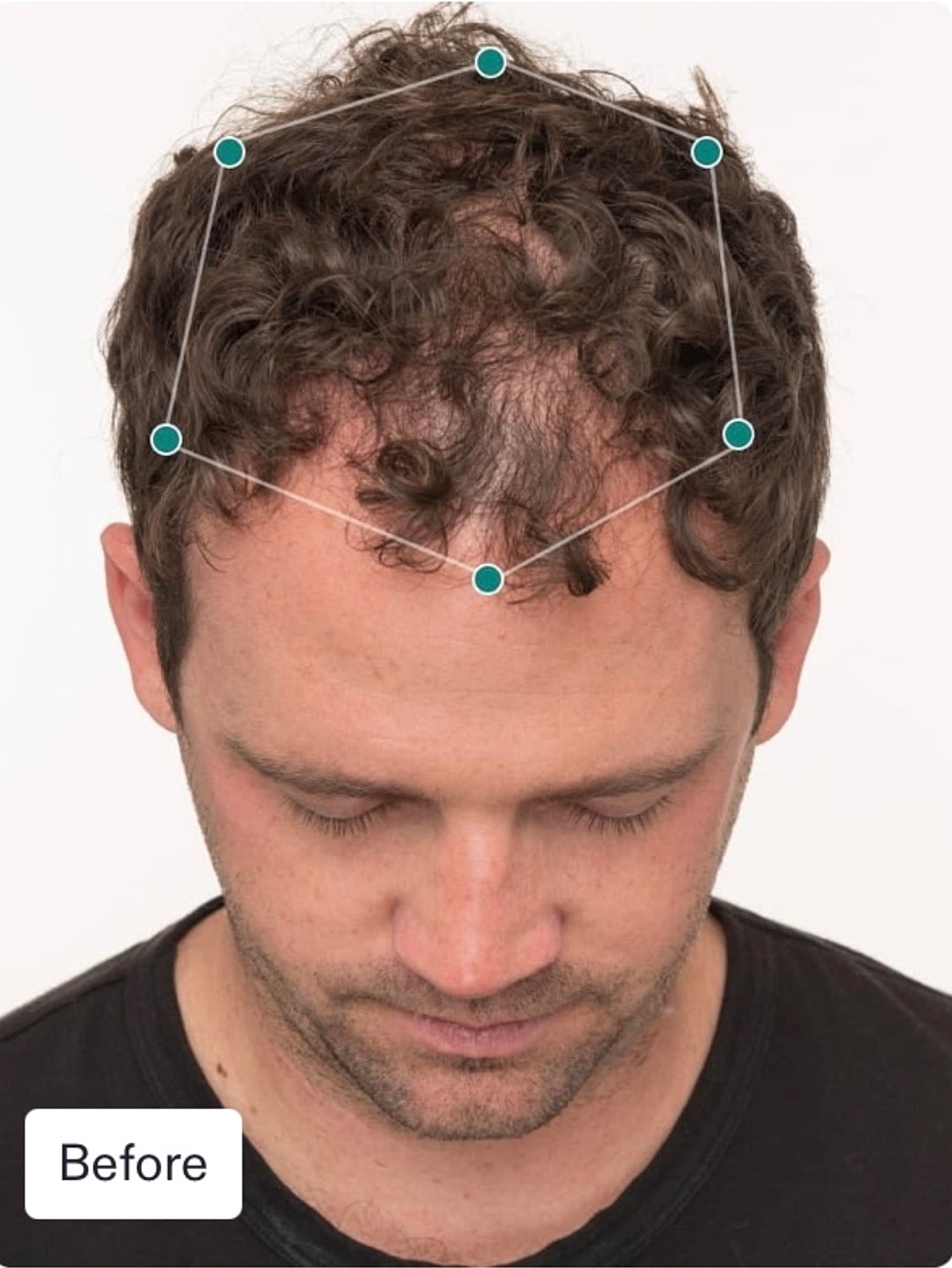 Nutrafol Gallery Before & After