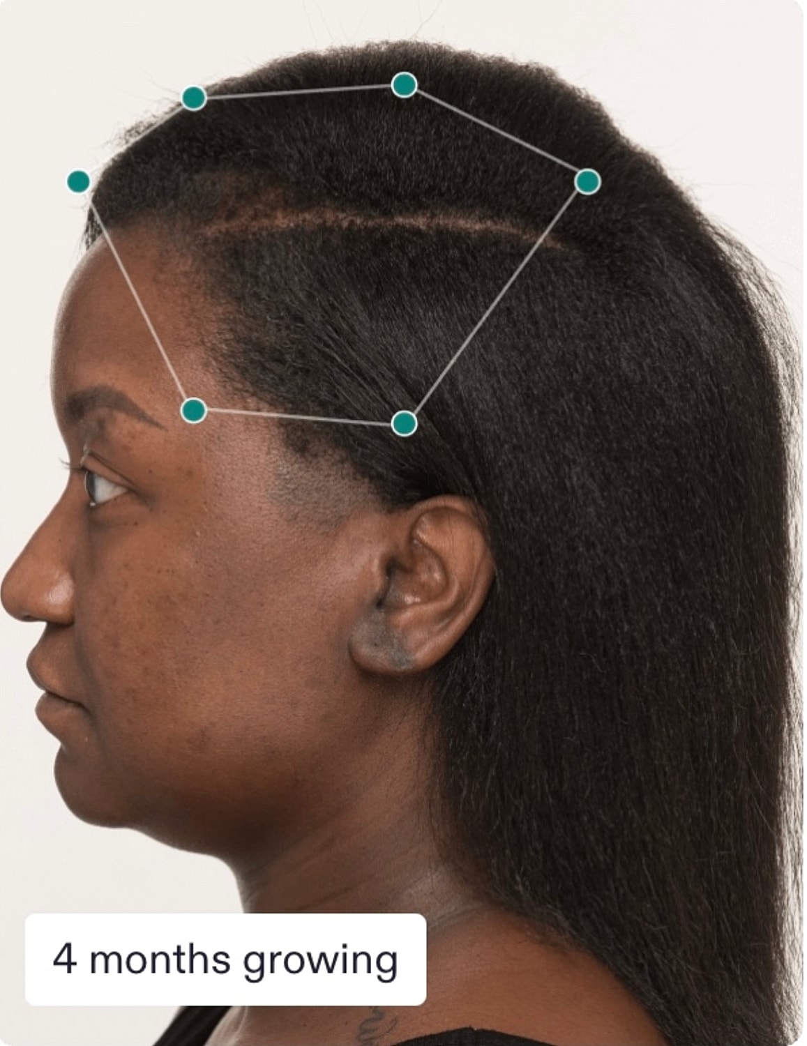 Nutrafol Gallery Before & After