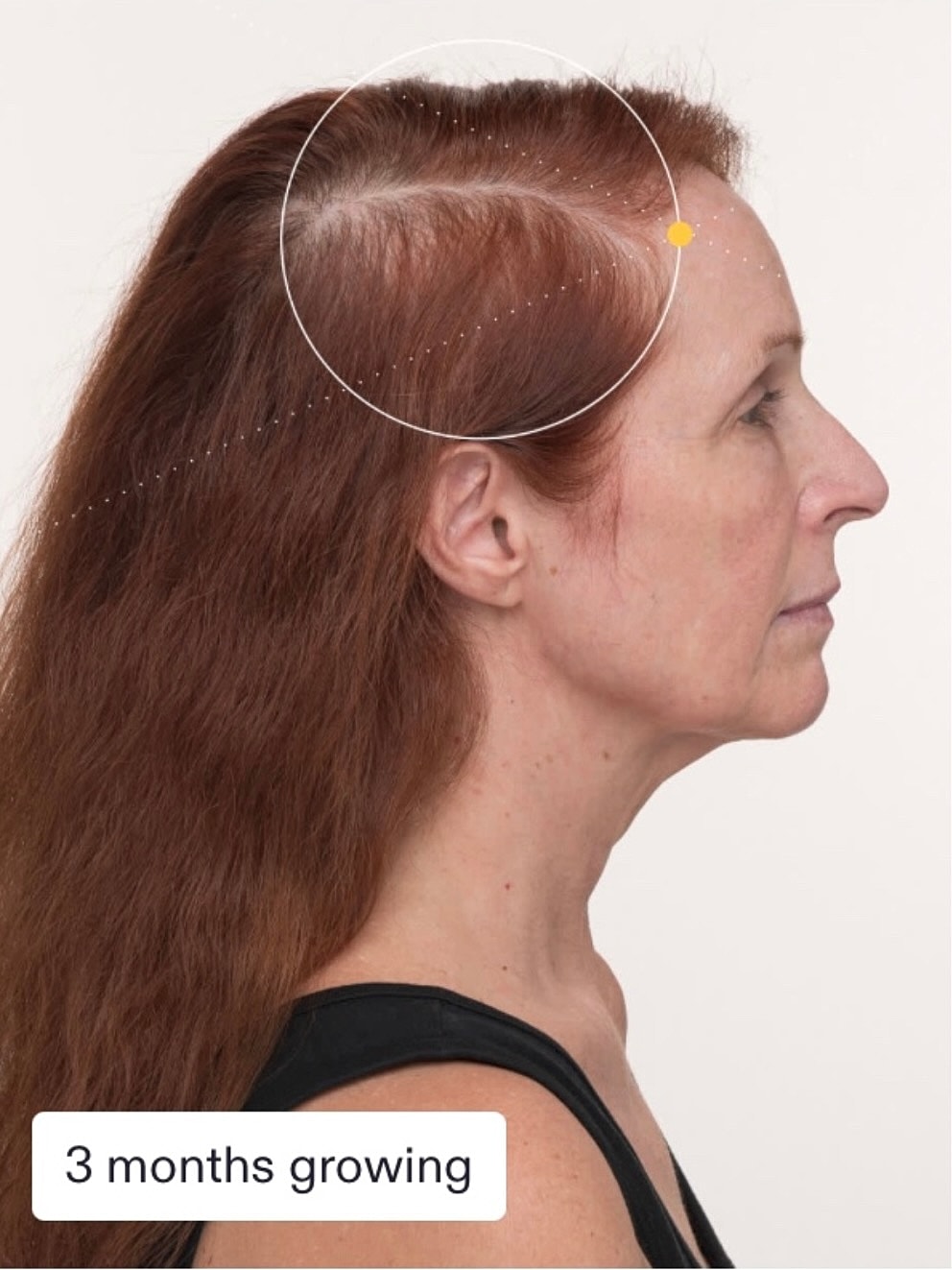 Nutrafol Gallery Before & After